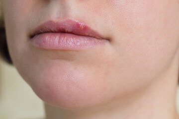 Home Remedies & Cures For Cold Cold Sores