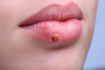 What Causes The Cold Sores