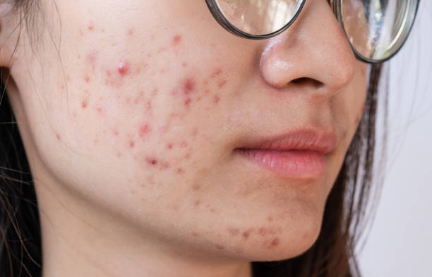Does Syntha 6 Cause Acne
